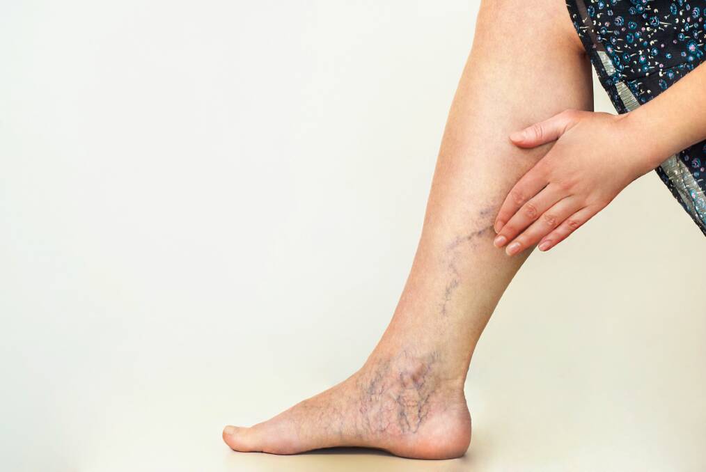 Uncomfortable: If varicose veins are bothering you due to the appearance, discomfort, or swelling, then you should get the opinion of a [vascular] specialist.